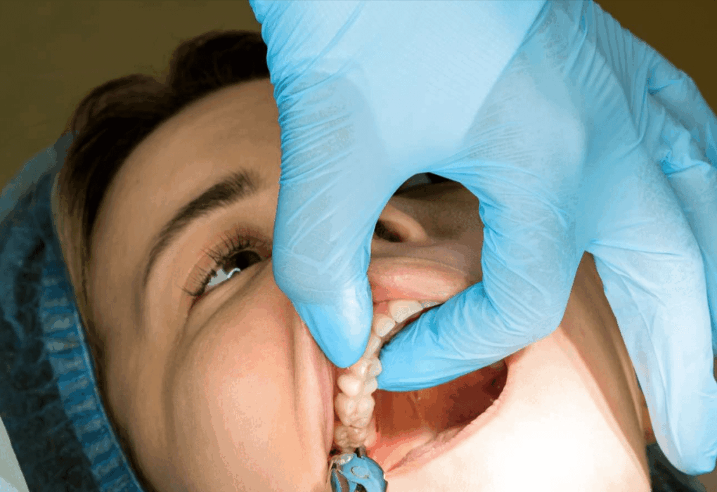 Wisdom Teeth Removal In Willowbrook What You Should Know Before The Procedure Teeth Removal