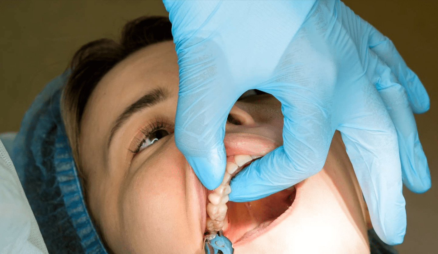Teeth Removal